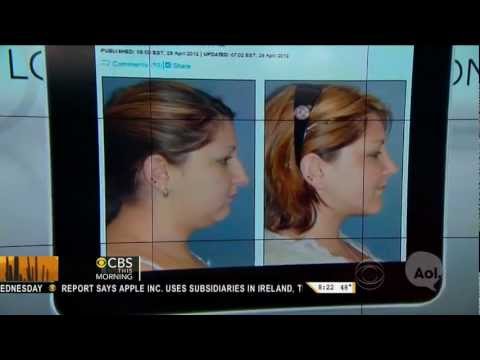 Before and after plastic surgery profile photos showing rhinoplasty results on television news broadcast