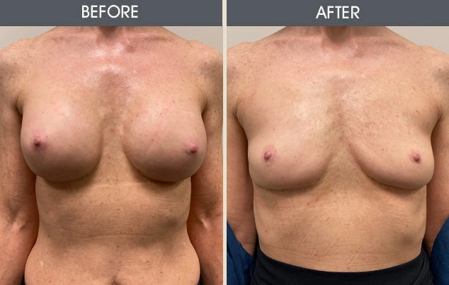 Real patient results in New York, NY Performed by Darrick E. Antell MD, FACS