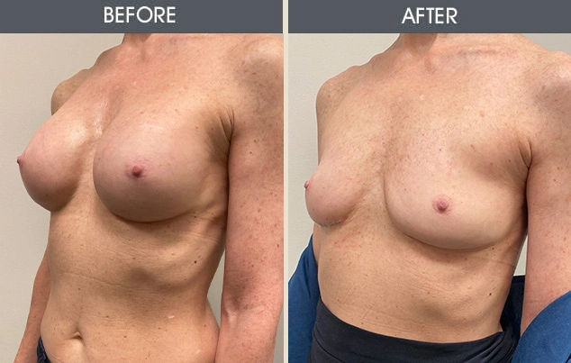 Real patient results in New York, NY Performed by Darrick E. Antell MD, FACS