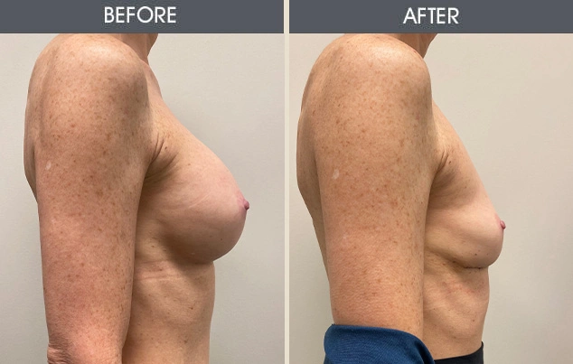 Real patient results in New York, NY Performed by Darrick E. Antell MD, FACS
