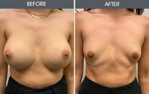 Real patient results in New York, NY Performed by Darrick E. Antell MD, FACS
