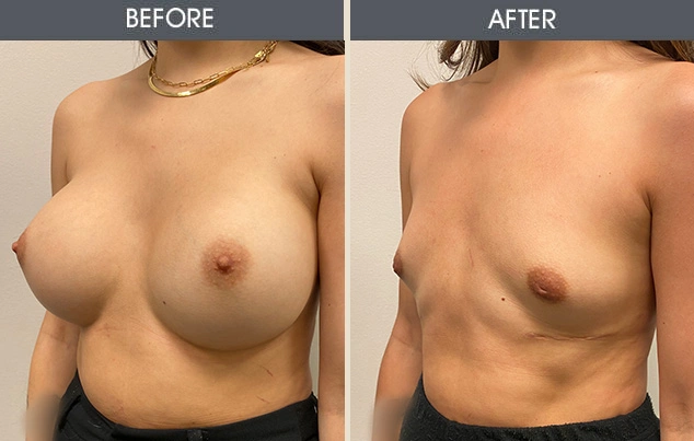 Real patient results in New York, NY Performed by Darrick E. Antell MD, FACS