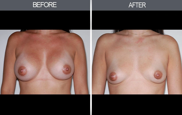 Real patient results in New York, NY Performed by Darrick E. Antell MD, FACS