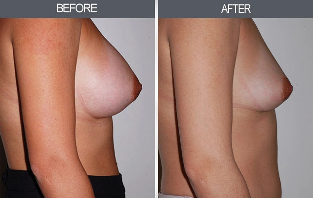 Real patient results in New York, NY Performed by Darrick E. Antell MD, FACS