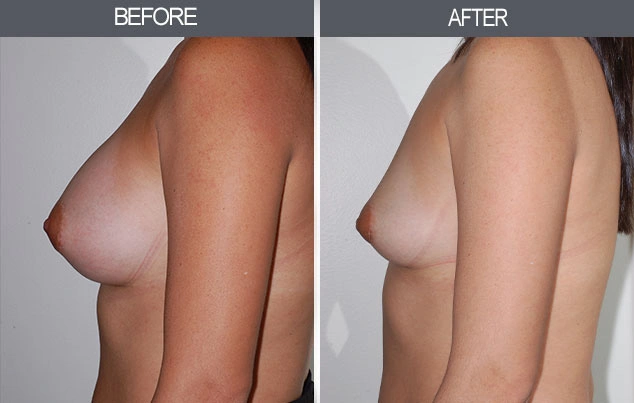 Real patient results in New York, NY Performed by Darrick E. Antell MD, FACS