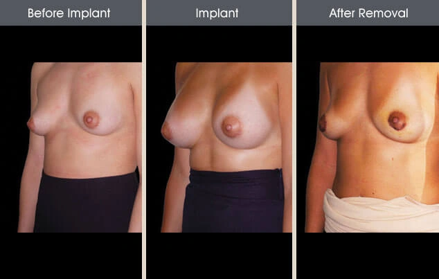 Real patient results in New York, NY Performed by Darrick E. Antell MD, FACS