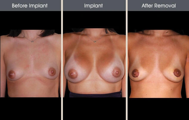 Real patient results in New York, NY Performed by Darrick E. Antell MD, FACS