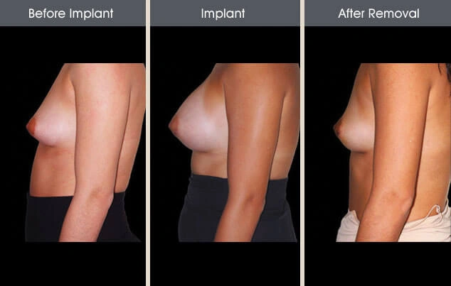 Real patient results in New York, NY Performed by Darrick E. Antell MD, FACS