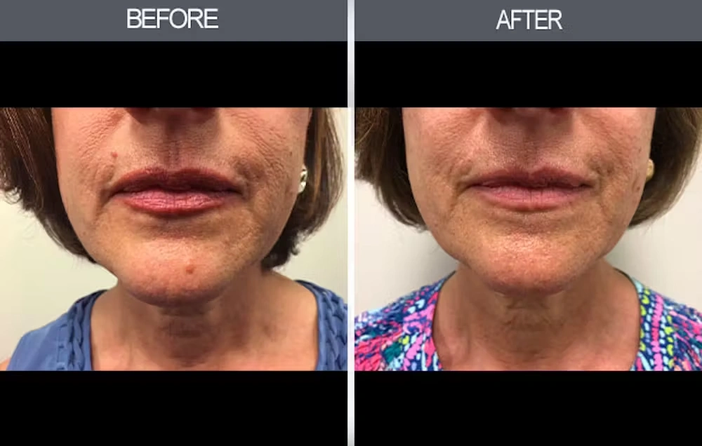 Real patient results in New York, NY Performed by Darrick E. Antell MD, FACS