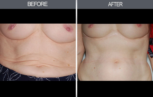 Real patient results in New York, NY Performed by Darrick E. Antell MD, FACS