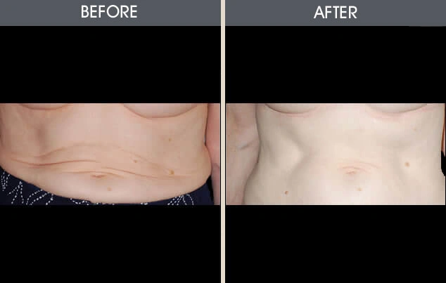 Real patient results in New York, NY Performed by Darrick E. Antell MD, FACS
