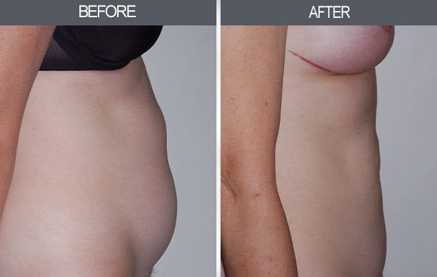 Real patient results in New York, NY Performed by Darrick E. Antell MD, FACS