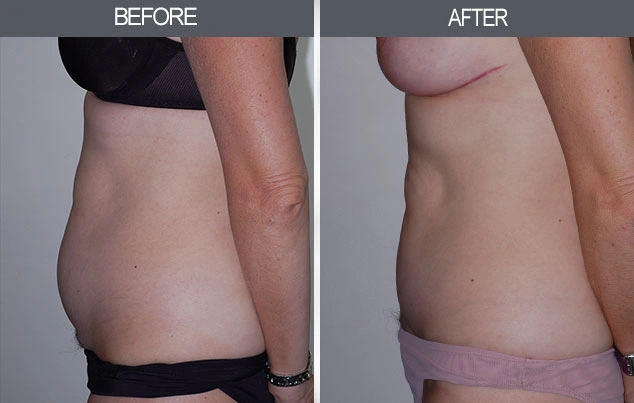 Real patient results in New York, NY Performed by Darrick E. Antell MD, FACS