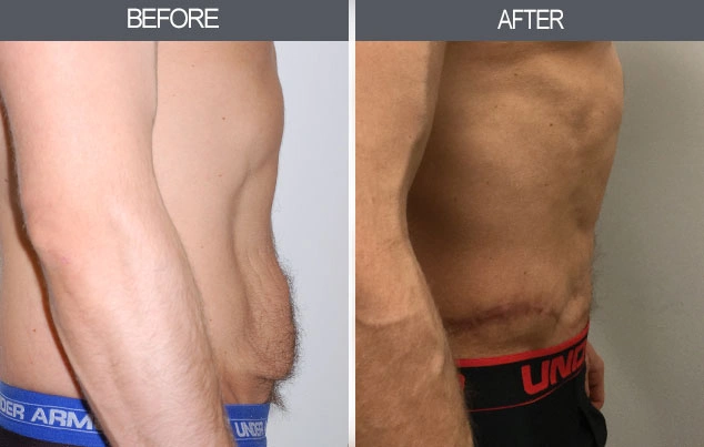 Real patient results in New York, NY Performed by Darrick E. Antell MD, FACS