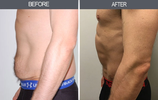 Real patient results in New York, NY Performed by Darrick E. Antell MD, FACS