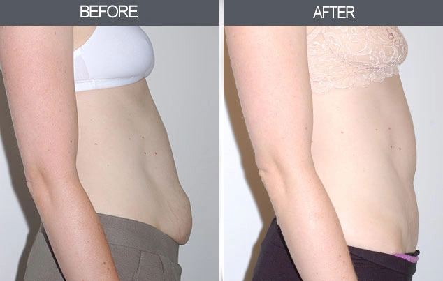 Real patient results in New York, NY Performed by Darrick E. Antell MD, FACS