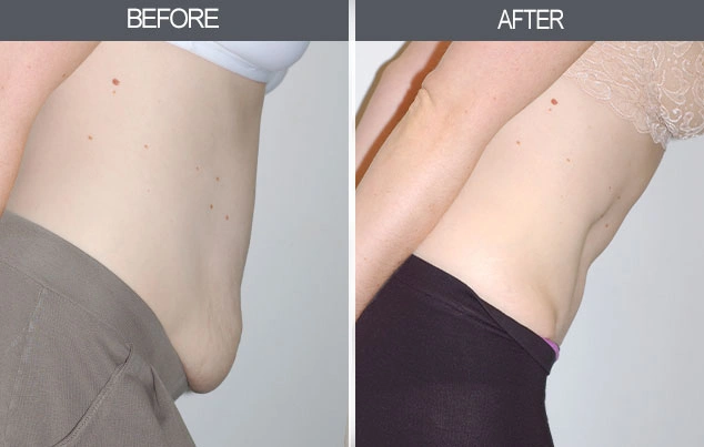 Real patient results in New York, NY Performed by Darrick E. Antell MD, FACS