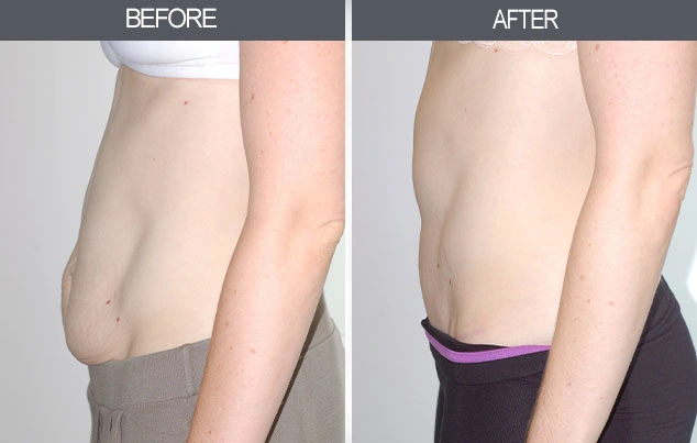 Real patient results in New York, NY Performed by Darrick E. Antell MD, FACS