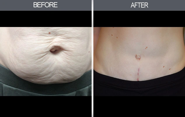 Real patient results in New York, NY Performed by Darrick E. Antell MD, FACS