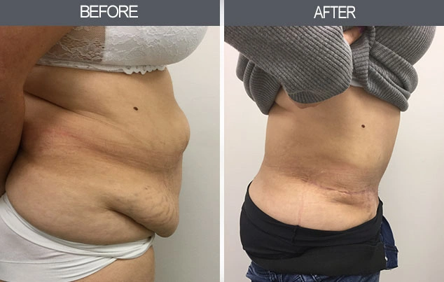 Real patient results in New York, NY Performed by Darrick E. Antell MD, FACS