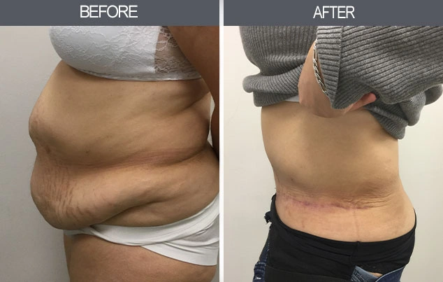 Real patient results in New York, NY Performed by Darrick E. Antell MD, FACS