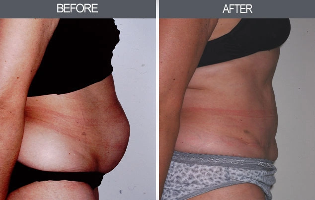 Real patient results in New York, NY Performed by Darrick E. Antell MD, FACS