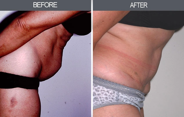 Real patient results in New York, NY Performed by Darrick E. Antell MD, FACS