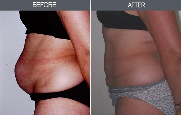 Real patient results in New York, NY Performed by Darrick E. Antell MD, FACS