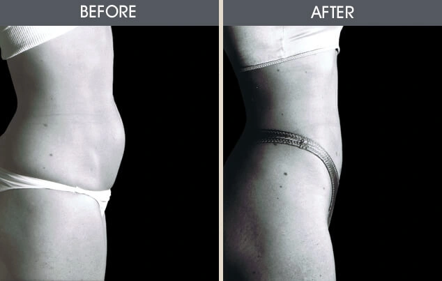 Real patient results in New York, NY Performed by Darrick E. Antell MD, FACS