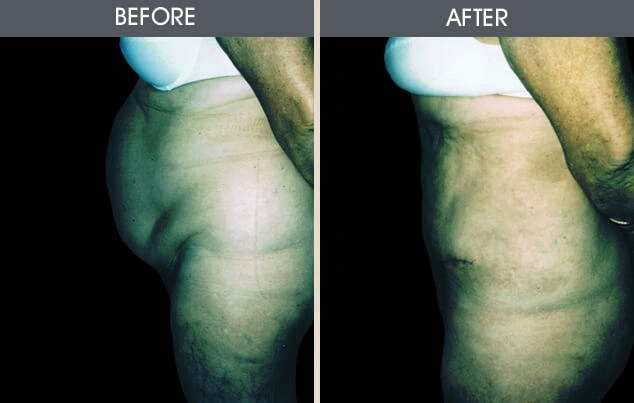 Real patient results in New York, NY Performed by Darrick E. Antell MD, FACS