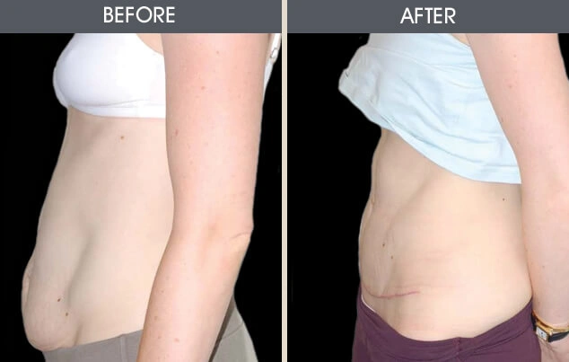Real patient results in New York, NY Performed by Darrick E. Antell MD, FACS