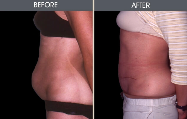 Real patient results in New York, NY Performed by Darrick E. Antell MD, FACS