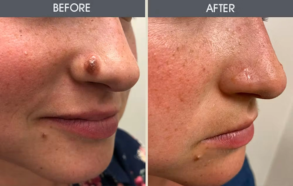 Real patient results in New York, NY Performed by Darrick E. Antell MD, FACS