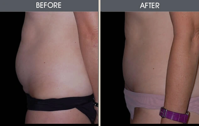 Real patient results in New York, NY Performed by Darrick E. Antell MD, FACS