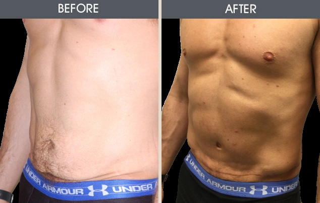 Real patient results in New York, NY Performed by Darrick E. Antell MD, FACS