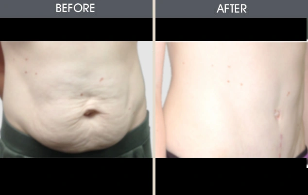 Real patient results in New York, NY Performed by Darrick E. Antell MD, FACS