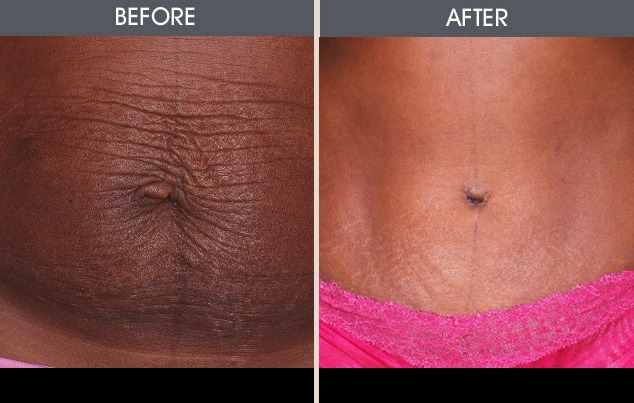Real patient results in New York, NY Performed by Darrick E. Antell MD, FACS