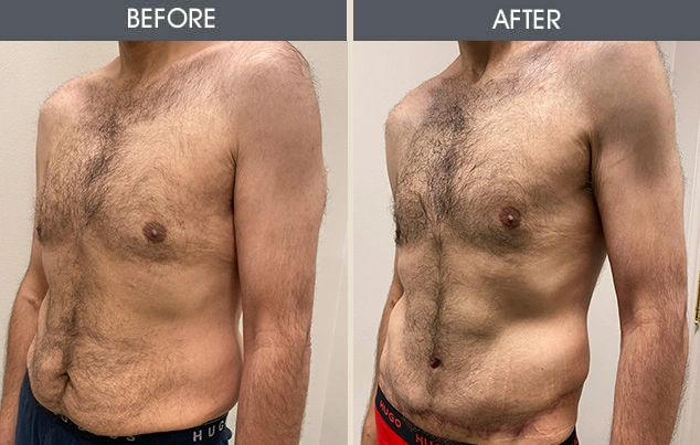 Real patient results in New York, NY Performed by Darrick E. Antell MD, FACS