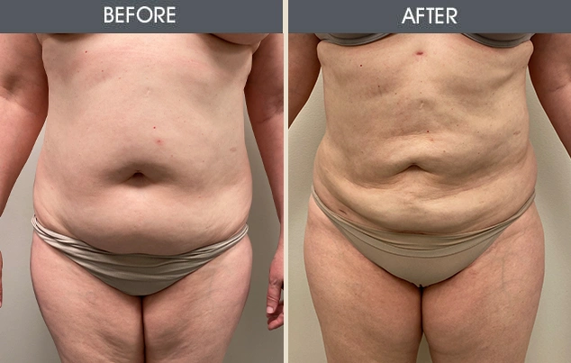 Real patient results in New York, NY Performed by Darrick E. Antell MD, FACS