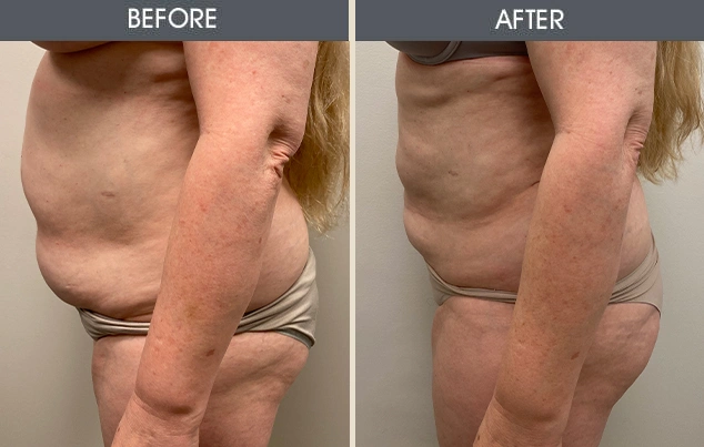Real patient results in New York, NY Performed by Darrick E. Antell MD, FACS