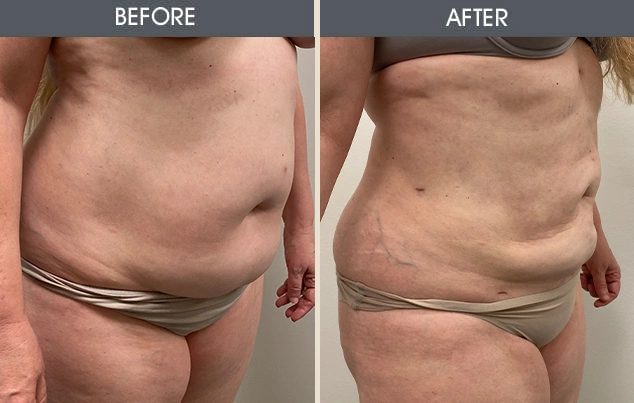 Real patient results in New York, NY Performed by Darrick E. Antell MD, FACS