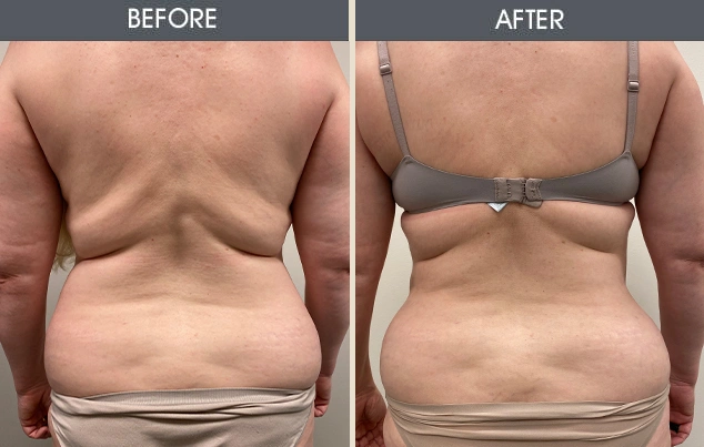 Real patient results in New York, NY Performed by Darrick E. Antell MD, FACS