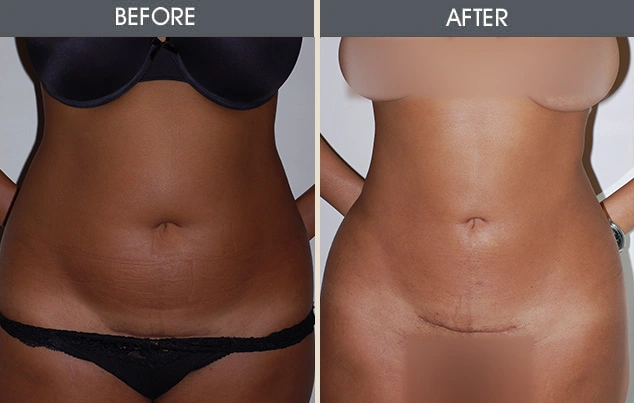 Real patient results in New York, NY Performed by Darrick E. Antell MD, FACS