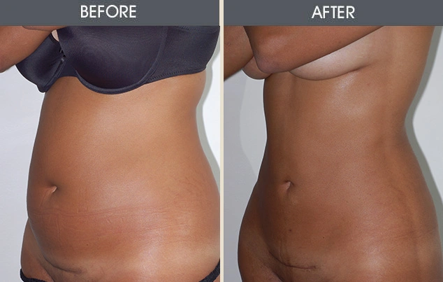 Real patient results in New York, NY Performed by Darrick E. Antell MD, FACS