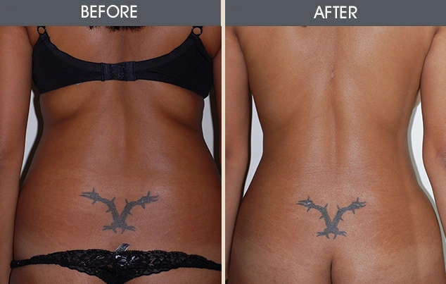 Real patient results in New York, NY Performed by Darrick E. Antell MD, FACS