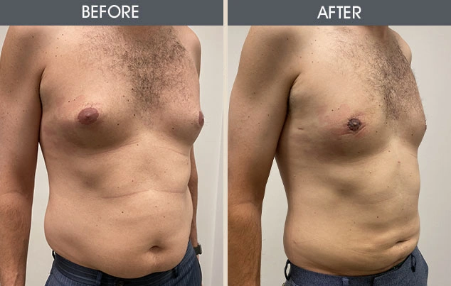 Real patient results in New York, NY Performed by Darrick E. Antell MD, FACS