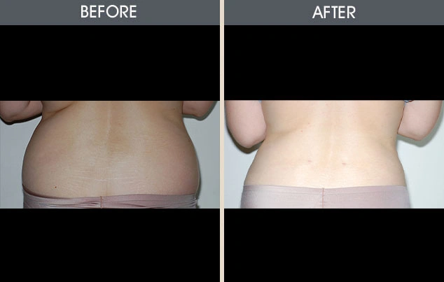 Real patient results in New York, NY Performed by Darrick E. Antell MD, FACS