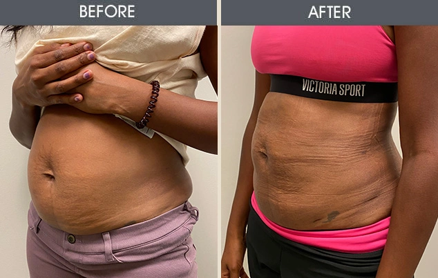Real patient results in New York, NY Performed by Darrick E. Antell MD, FACS