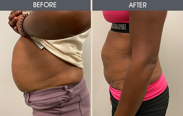 Real patient results in New York, NY Performed by Darrick E. Antell MD, FACS