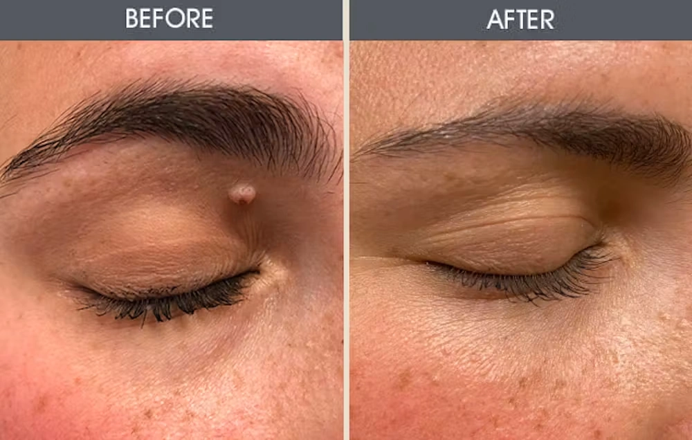 Real patient results in New York, NY Performed by Darrick E. Antell MD, FACS